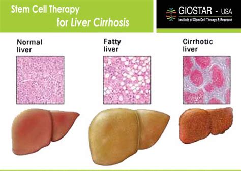 stem cell therapy for liver cirrhosis liver disease treatment in india