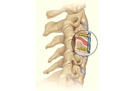 Anterior Cervical Discectomy And Fusion Jandj Medical Devices
