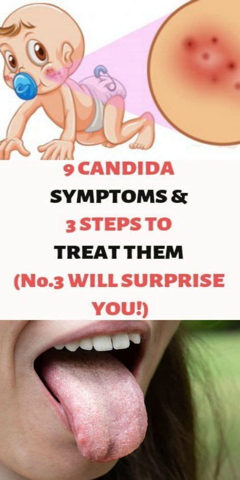 9 Candida Symptoms And 3 Steps To Treat Them Candida Symptoms Yeast