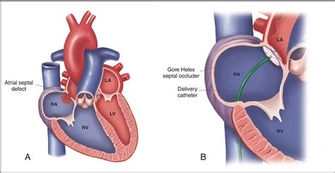 long term complications  congenital heart defect repair   charts