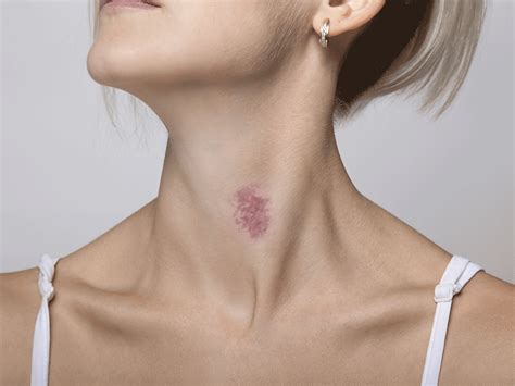 dermatologists tell us exactly how to get rid of a hickey