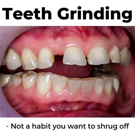 grinding  teeth dr wenricks blog dentist tmj specialist