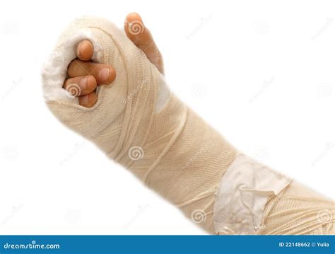 broken arm stock photography image