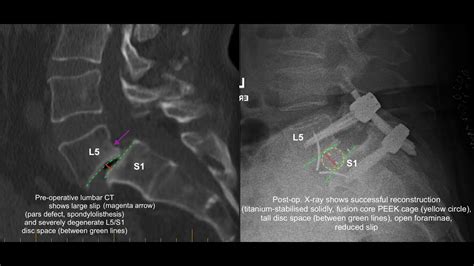 art  modern spinal surgery  degree front  spinal reconstr  severe ls degen