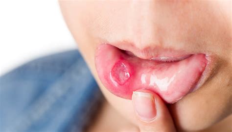 The Truth Behind Canker Sores Causes Of Canker Sores