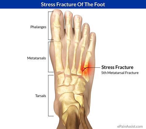 bone stress facture sports physio gold