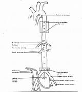 Umbilical Artery Aorta Catheter Placement Uvc Branches Newborn Vein Catheters Intravascular Gif Inserted Showing Into Large sketch template