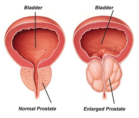 Benign Prostatic Hyperplasia Bph Enlarged Prostate An Overview