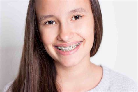¿cuándo Es Necesaria La Ortodoncia En Adolescentes Ed Barcelona
