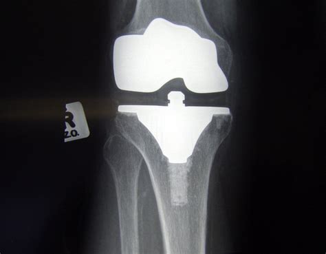 knee replacement front view  photo  freeimages