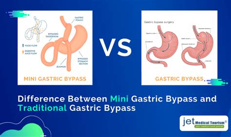 Mini Gastric Bypass Vs Gastric Bypass Jet Medical