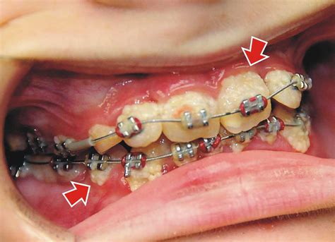 How Do You Treat White Spots After Braces Ask An