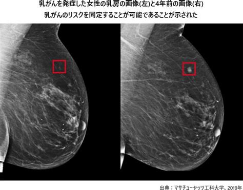 Aiで乳がんの5年後の発症リスクを予測 マンモグラフィ検査の精度を大幅に向上 ニュース 保健指導リソースガイド