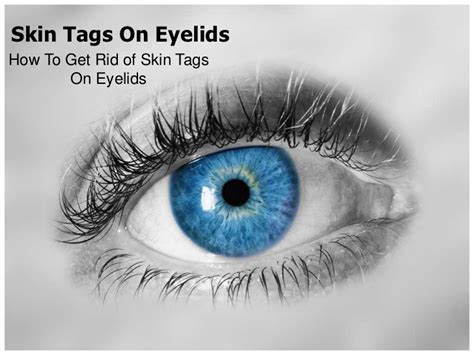 skin tags on eyelids