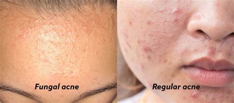 How To Identify Fungal Acne And Treatments To Make It Disappear From Your