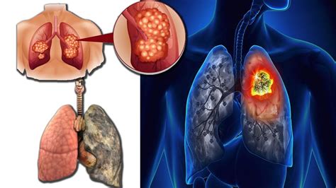 Lung Cancer Symptoms Signs Stages Treatment And Types Youtube