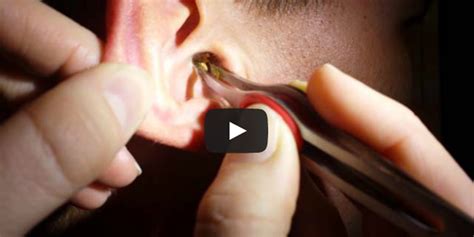 Watch Someone Pull Out A Monstrous Chunk Of Ear Wax And Try Not To Hurl