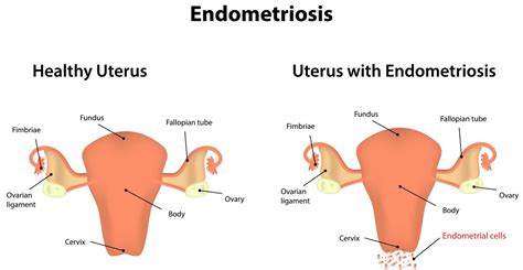 authophagy activation  contribute  ovarian endometriosis pathogenesis
