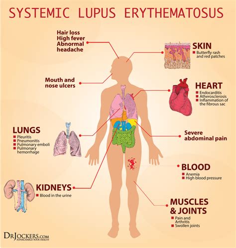 ways  heal systemic lupus naturally drjockerscom