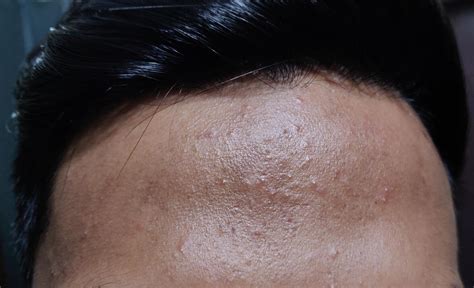 skin concern    red  bumps filled  forehead