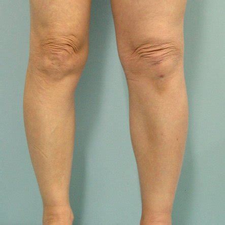 photograph showing  swelling   left leg
