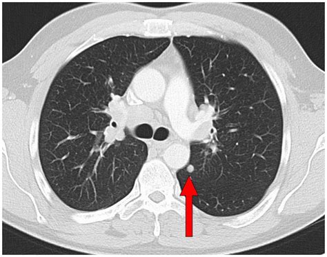 Axial Slide Of A Ct Scan Of The Chest Lung Window Findings Before The