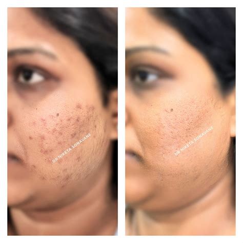 pigmentation treatment  mumbai cost    results