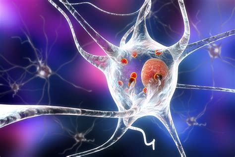 study reveals roots  parkinsons disease   brain ellinescom