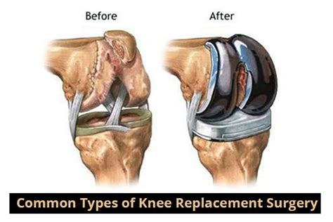 Common Types Of Knee Replacement Surgery