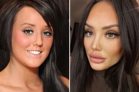 Inside Charlotte Crosby S £20k Face And Surgery Journey After Boob Jobs