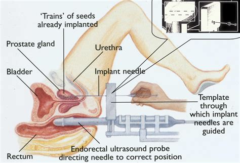 Proper anal sex procedure