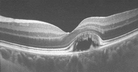 Best Disease Oct Fovea Oct Image Through The Fovea In A Patient With