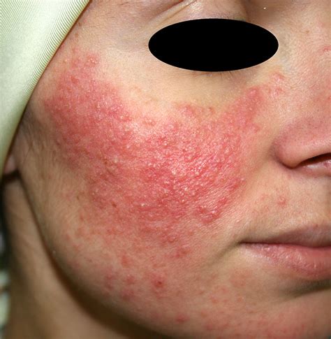 acne rosacea intechopen