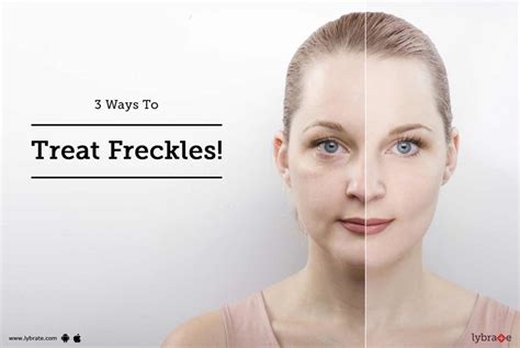 3 Ways To Treat Freckles By Dr Raghuram Reddy Lybrate