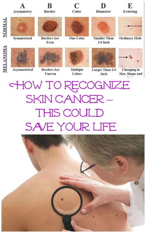 Skin Cancer Spots