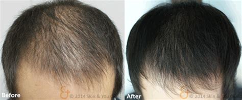 hair regrowth procedure hair treatment  men  women