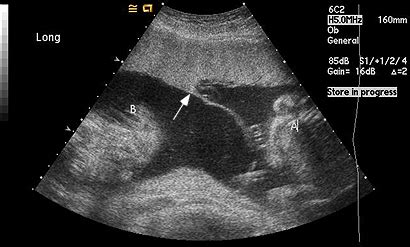 case   day ultrasound