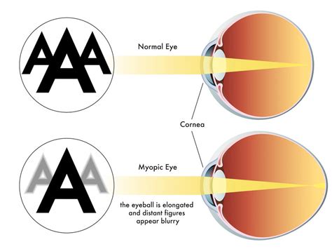 myopia hyperopia astigmatism whats