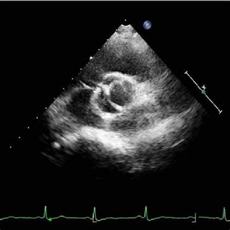 Echocardiogram Revealing Bicuspid Aortic Valve Disease Download