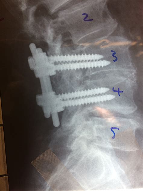 Preparing For A Lumbar Spinal Fusion Front Range Spine And Neurosurgery