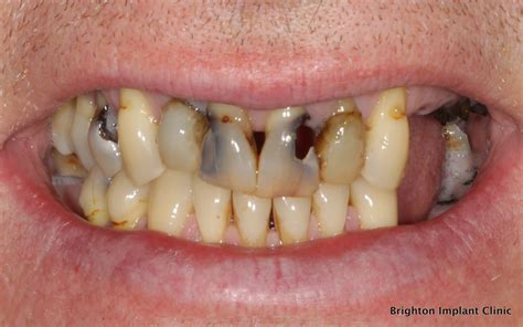 bad teeth decayed teeth affected dental implants
