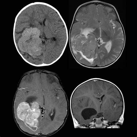 pediatric choroid plexus carcinoma pediatric radiology reference