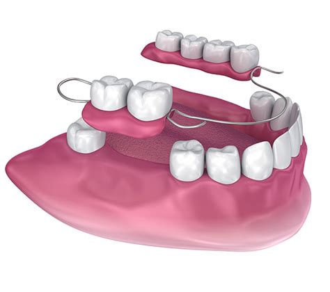 partial dentures   teeth virginia beach va periodontal gum