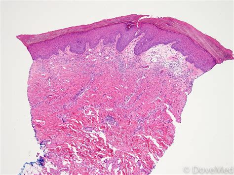 lichen sclerosus of vulva