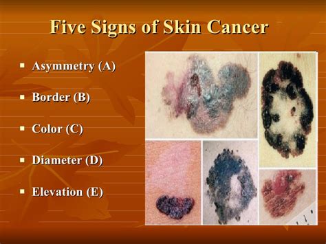 five signs of skin cancer at