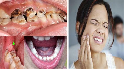 stop tooth nerve pain