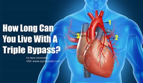 how long can you live with a triple bypass