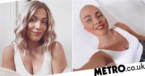 Woman With Alopecia Ditches Her Wigs And Celebrates Her