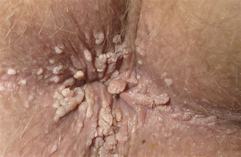 Anal itch hpv