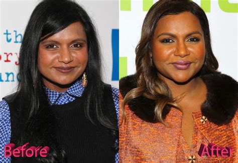 mindy kaling plastic surgery  project